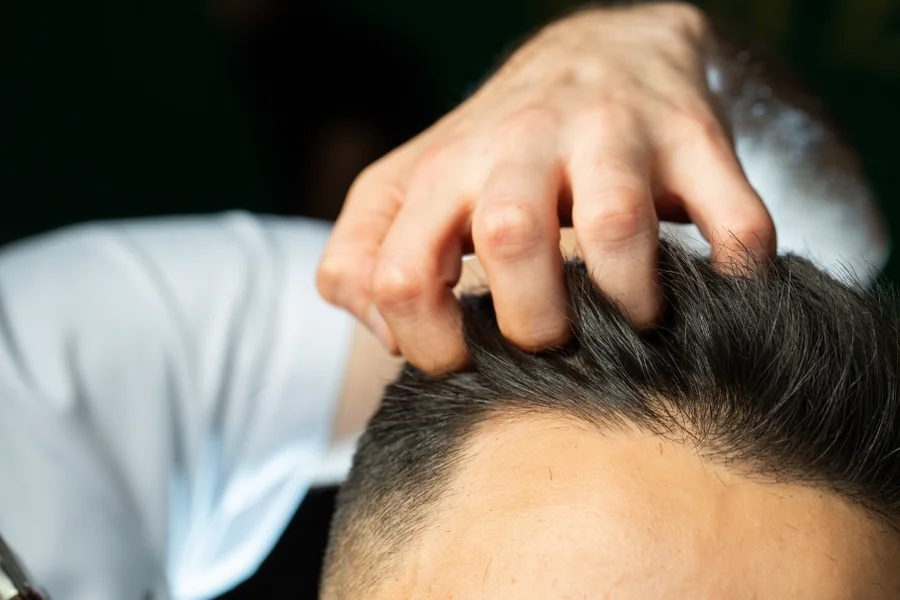 Hair Transplants